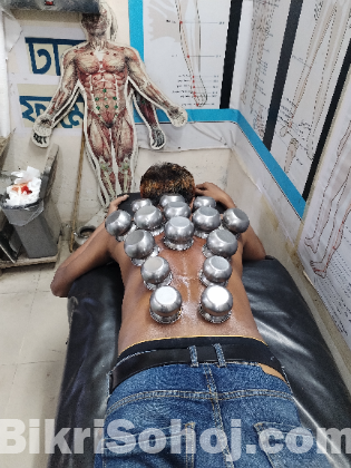 Hijama acupuncture treatment